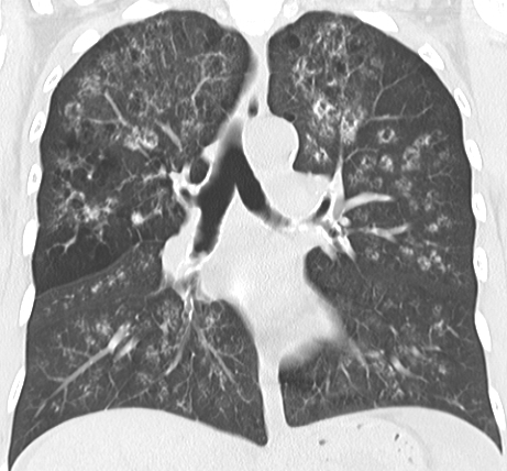 File:Calciphylaxis and metastatic pulmonary calcification (Radiopaedia 10887-11317 Coronal lung window 1).jpg