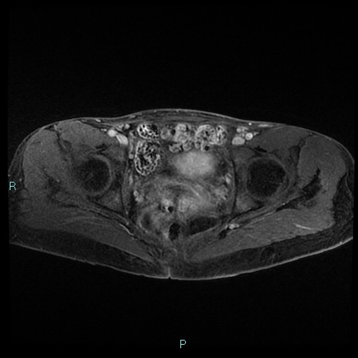 File:Canal of Nuck cyst (Radiopaedia 55074-61448 Axial T1 C+ fat sat 37).jpg