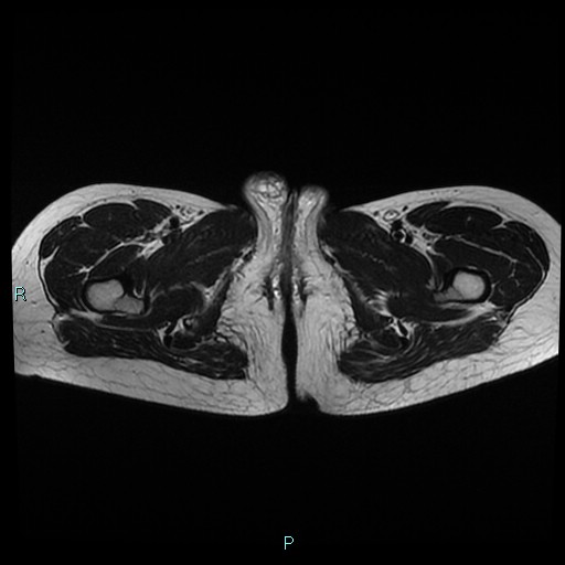 File:Canal of Nuck cyst (Radiopaedia 55074-61448 Axial T2 25).jpg