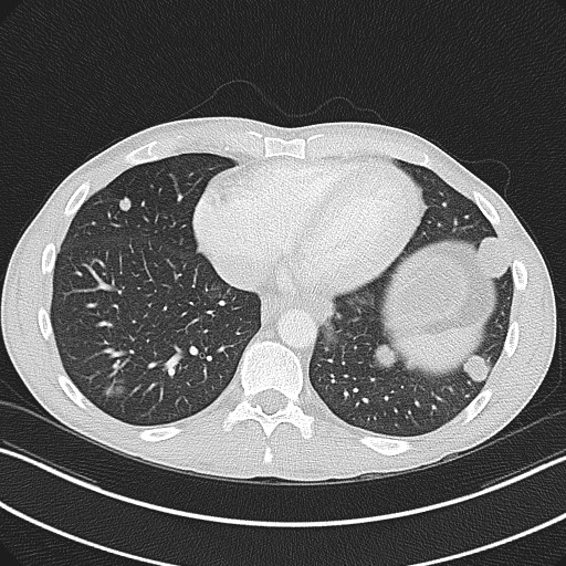 File:Cannonball metastases - testicular choriocarcinoma (Radiopaedia 84510-99891 Axial lung window 71).jpg