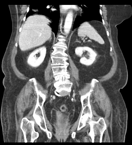 Cannonball metastases from endometrial cancer (Radiopaedia 42003-45031 F 44).png