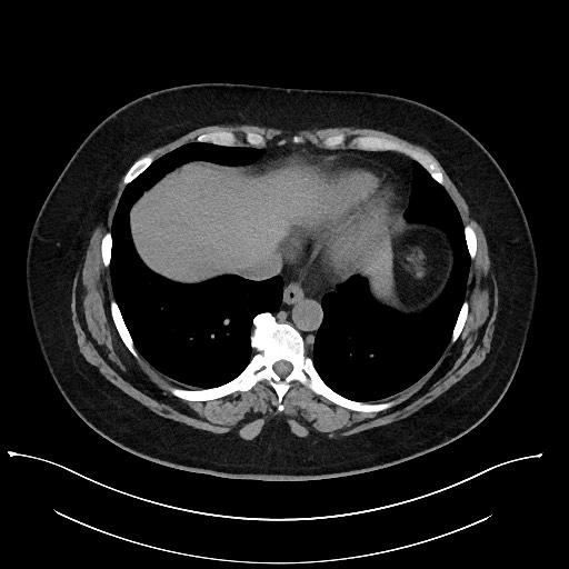Carcinoid tumor - terminal ileum (Radiopaedia 60931-68740 Axial non-contrast 1).jpg