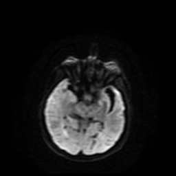 Carcinoma ex-pleomorphic adenoma of parotid (Radiopaedia 28383-28627 Ax DWI B-500 GE 70).jpg