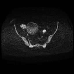 Carcinoma of the cervix (Radiopaedia 89018-105858 Axial DWI 59).jpg