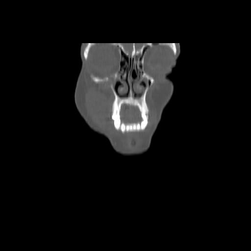 Carcinoma of the maxillary antrum (Radiopaedia 53805-59888 Coronal bone window 22).jpg