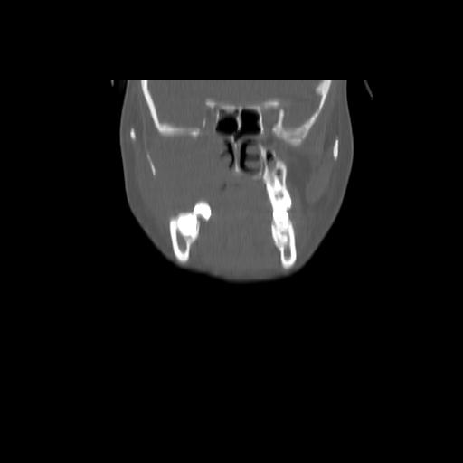 Carcinoma of the maxillary antrum (Radiopaedia 53805-59888 Coronal bone window 52).jpg