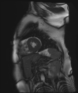 Cardiac amyloidosis (Radiopaedia 51404-57150 Sagittal CINE SSFP 111).jpg