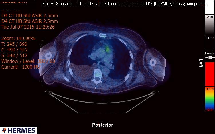 File:Cardiac lymphoma (Radiopaedia 38690-40871 Integrated PET-CT 5).jpg
