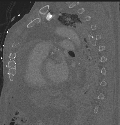 Cardiac trauma (Radiopaedia 32874-33858 Sagittal bone window 15).jpg