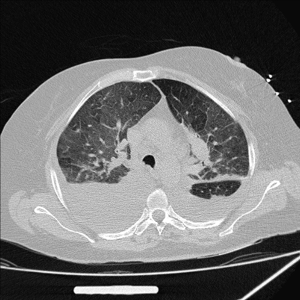 Cardiogenic pulmonary edema (Radiopaedia 29213-29609 Axial lung window 31).jpg