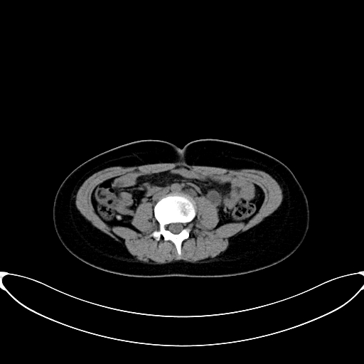 Caroli disease with medullary sponge kidney (Radiopaedia 82622-96804 Axial non-contrast 41).jpg