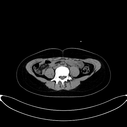 Caroli disease with medullary sponge kidney (Radiopaedia 82622-96804 Axial non-contrast 46).jpg