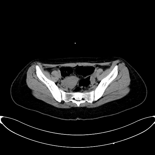 Caroli disease with medullary sponge kidney (Radiopaedia 82622-96804 Axial non-contrast 62).jpg