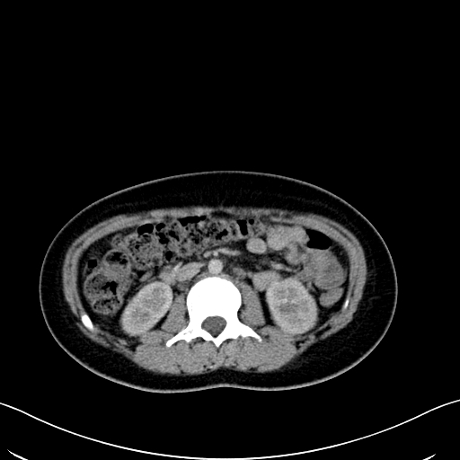 Caroli disease with medullary sponge kidney (Radiopaedia 82622-96804 C 34).jpg