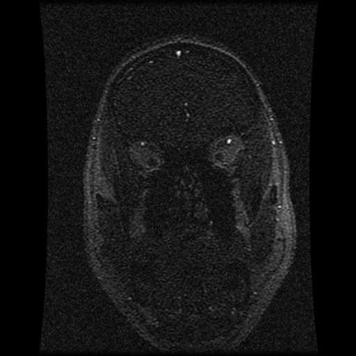 Carotid arterial dissection with acute cerebral infarction (Radiopaedia 26636-26784 MRV 127).jpg