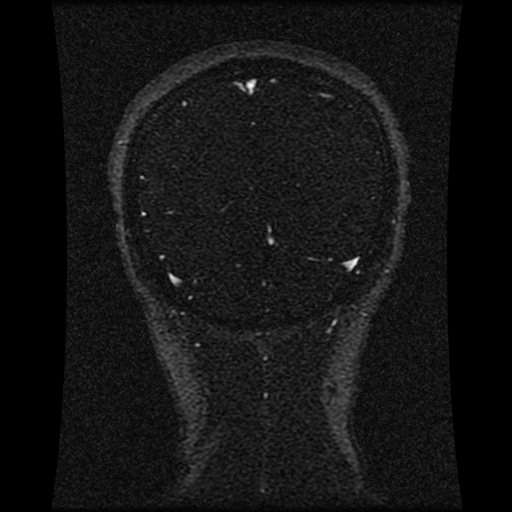 Carotid arterial dissection with acute cerebral infarction (Radiopaedia 26636-26784 MRV 54).jpg