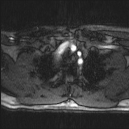Carotid artery dissection (Radiopaedia 28441-28689 Axial MRA 3).jpg