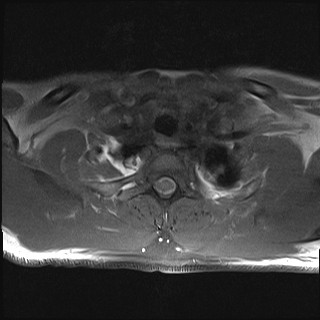 File:Carotid artery dissection (Radiopaedia 28441-28689 Axial T1 fat sat 5).jpg