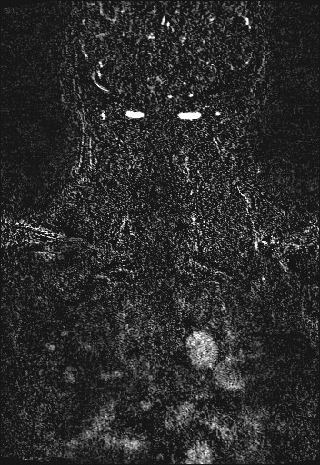 Carotid artery dissection (Radiopaedia 28441-28689 Coronal MRA 85).jpg