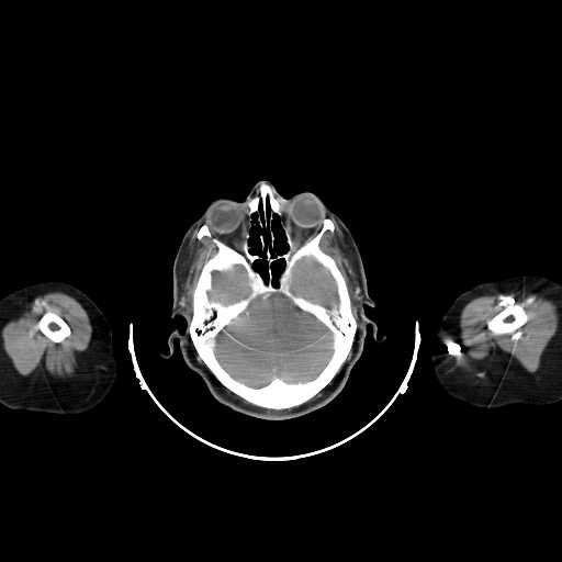 Carotid body tumor (Radiopaedia 21021-20948 A 7).jpg