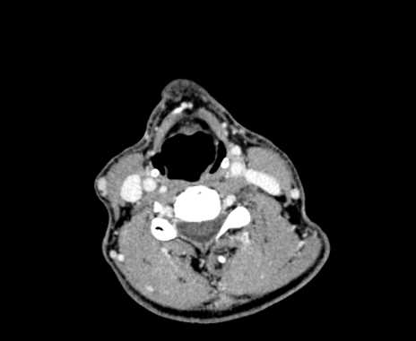 Carotid body tumor (Radiopaedia 61750-69757 Axial Post contrast 67).jpg