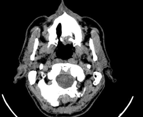 Carotid body tumor (Radiopaedia 61750-69757 Axial non-contrast 6).jpg