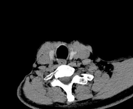 Carotid body tumor (Radiopaedia 61750-69757 Axial non-contrast 91).jpg