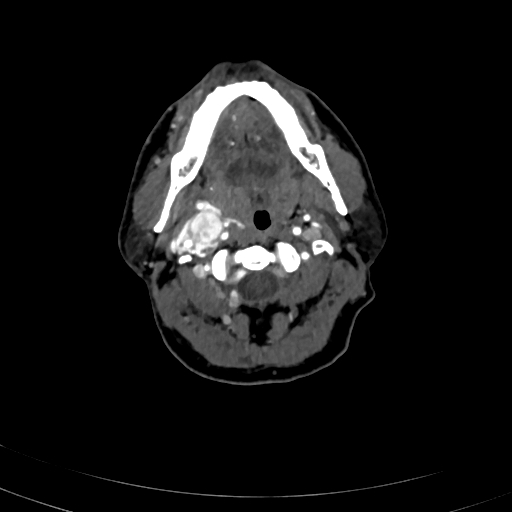 File:Carotid body tumor (Radiopaedia 83615-98727 A 42).jpg