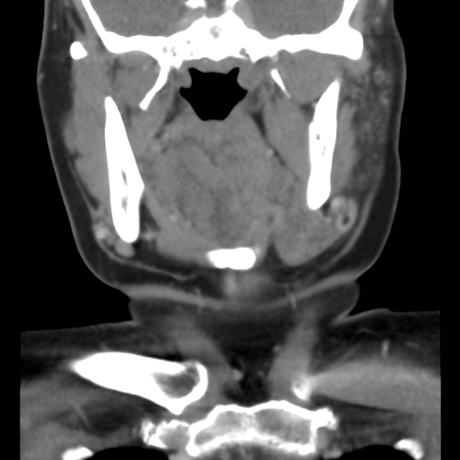 File:Carotid body tumor (paraganglioma) (Radiopaedia 38586-40729 B 17).jpg