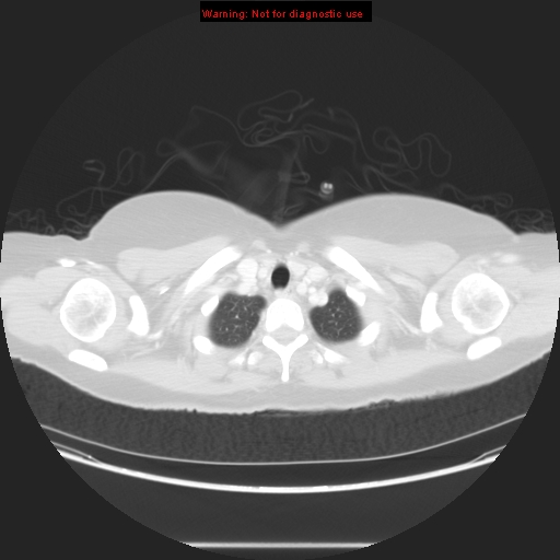 Carotid body tumor with lung metastases (Radiopaedia 9301-48390 Axial lung window 13).jpg