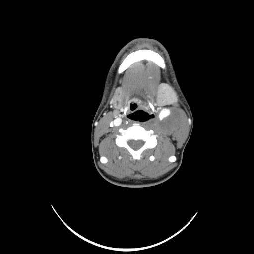 Carotid bulb pseudoaneurysm (Radiopaedia 57670-64616 A 35).jpg