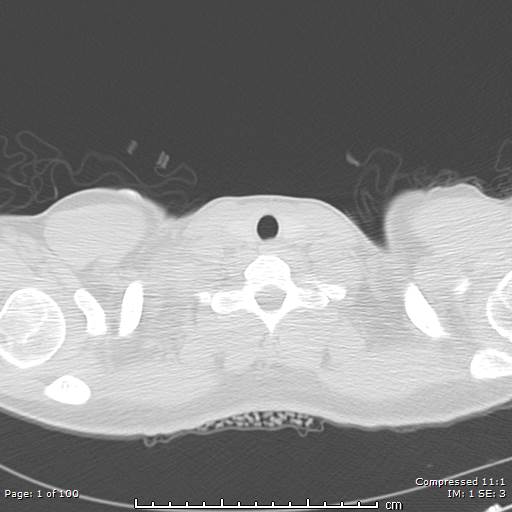 Catamenial pneumothorax (Radiopaedia 54382-60600 Axial non-contrast 1).jpg