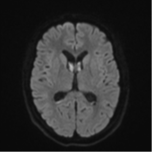 File:Cavernoma with bleed - midbrain (Radiopaedia 54546-60774 Axial DWI 42).png