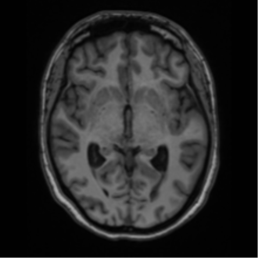 File:Cavernoma with bleed - midbrain (Radiopaedia 54546-60774 Axial T1 19).png