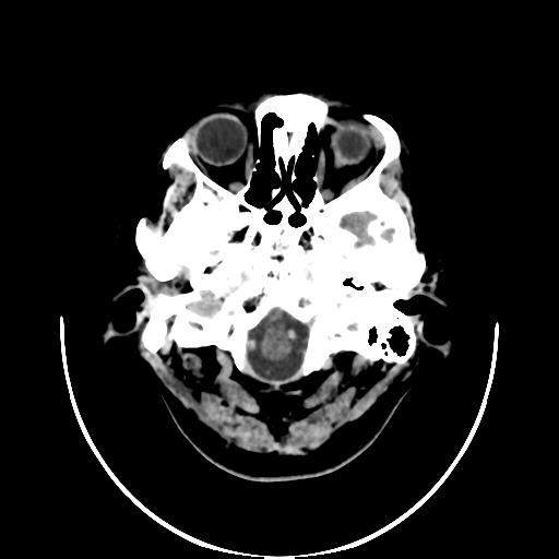 File:Cavernoma with developmental venous anomaly (Radiopaedia 22470-22506 non-contrast 2).jpg