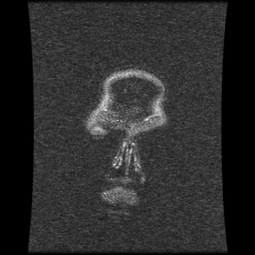 Cavernoma with developmental venous anomaly (Radiopaedia 22470-22507 MRV 122).jpg