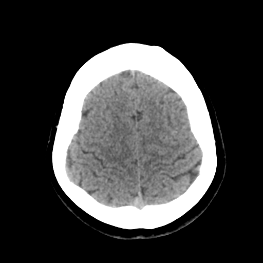 Cavernoma with hemorrhage (Radiopaedia 70755-80931 Axial non-contrast 43).png