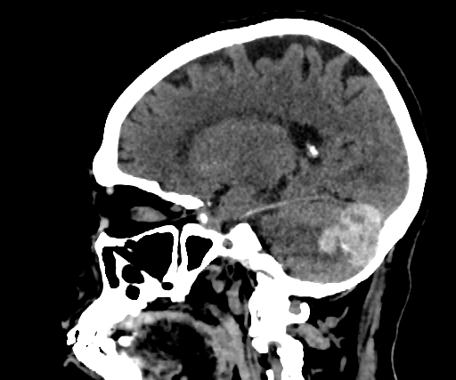 Cavernous hemangioma of the cerebellar falx (Radiopaedia 73025-83723 B 125).jpg