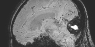 Cavernous hemangioma of the cerebellar falx (Radiopaedia 73025-83724 Sagittal BOLD 114).jpg