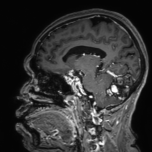 Cavernous hemangioma of the cerebellar falx (Radiopaedia 73025-83724 Sagittal T1 C+ 122).jpg