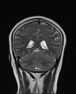 File:Cavernous sinus meningioma (Radiopaedia 63682-72367 Coronal T2 15).jpg