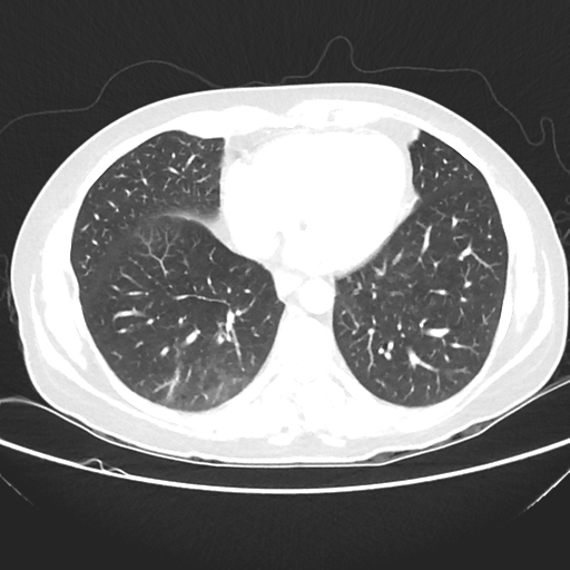 File:Cavitating lung mass - squamous cell carcinoma (Radiopaedia 48047-52854 Axial lung window 34).png