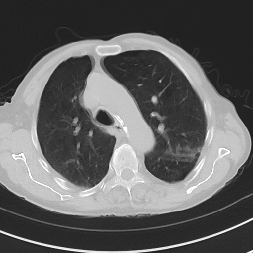 Cavitating pneumonia - lingular segments (Radiopaedia 34386-35678 Axial lung window 21).png