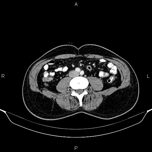 Cecal adenocarcinoma (Radiopaedia 85324-100916 B 58).jpg