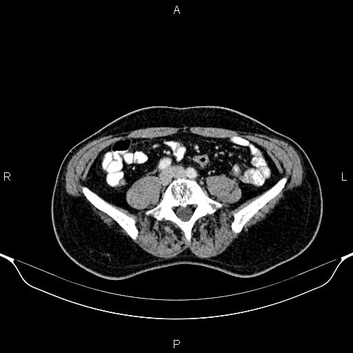 Cecal adenocarcinoma (Radiopaedia 85324-100916 B 63).jpg