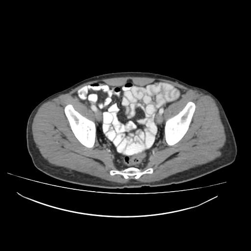 File:Cecal carcinoma with local lymphadenopathy (Radiopaedia 31428-32240 A 46).jpg
