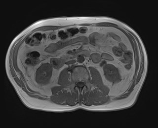 Cecal mass causing appendicitis (Radiopaedia 59207-66532 Axial T1 in-phase 69).jpg