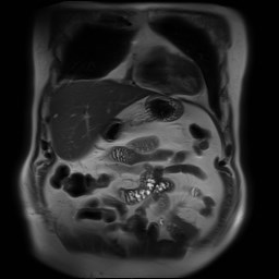 File:Cecal mass causing appendicitis (Radiopaedia 59207-66532 Coronal T2 9).jpg