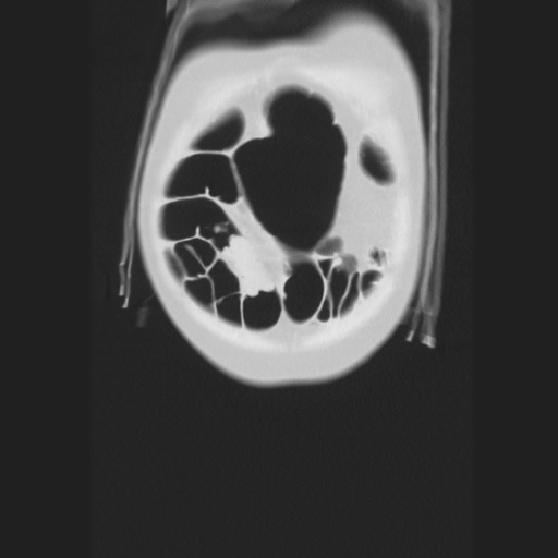 Cecal volvulus (Radiopaedia 75378-86620 Coronal lung window 22).jpg