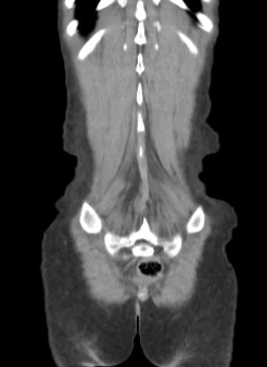 Cecal volvulus with pneumatosis coli (Radiopaedia 68572-78178 B 5).jpg